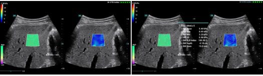 STE – звуковая сенсорная эластография – повышает качество и чёткость изображений УЗИ-аппарата Mindray Consona N7