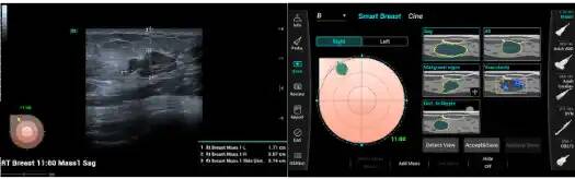 Ультразвуковые диагностические системы серии Consona N предлагают уникальный инструмент исследования молочной железы Smart Breast