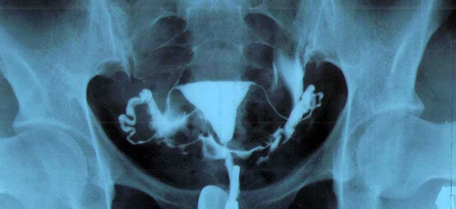 диагностика проходимости маточных труб