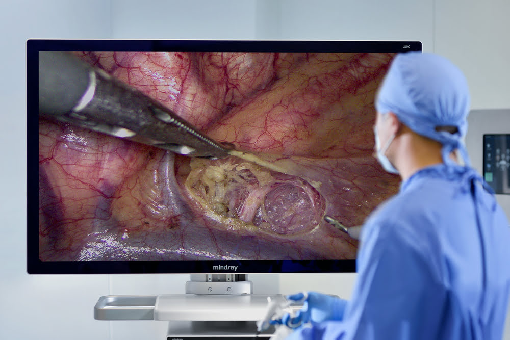 Mindray HyPixel U1: увеличение изображения без потери качества и в естественных цветах на мониторе 55