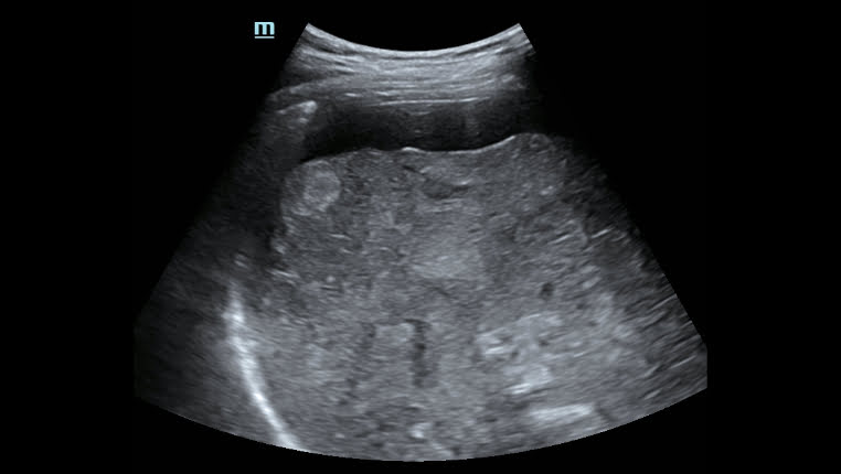 Определение ацистита печени Mindray Hepatus 5