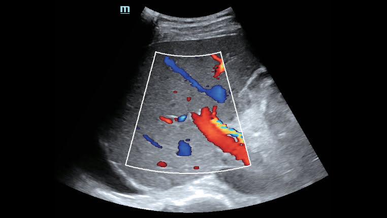 Mindray Hepatus 5 позволяет проводить оценку портальной гемодинамики