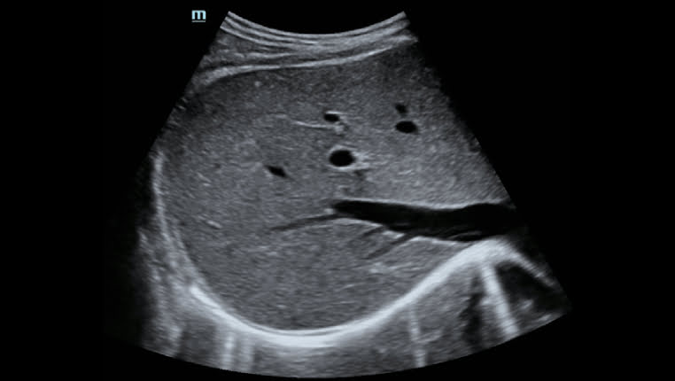 Mindray Hepatus 5 позволяет проводить оценку морфологии печени