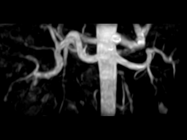 В неврологии Philips Ingenia Ambition 1.5T S позволяет обеспечить точную и быструю визуализацию при диагностике сосудистых заболеваний, нейропатии, болезни Альцгеймера.