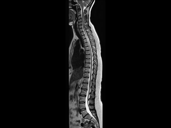 При исследованиях плечевого и пояснично-крестцового сплетения технология 3D NerveVIEW повышает качество визуализации нервных сплетений благодаря T2-взвешенному сканированию высокого разрешения с подавлением сигнала от жира и сосудов.