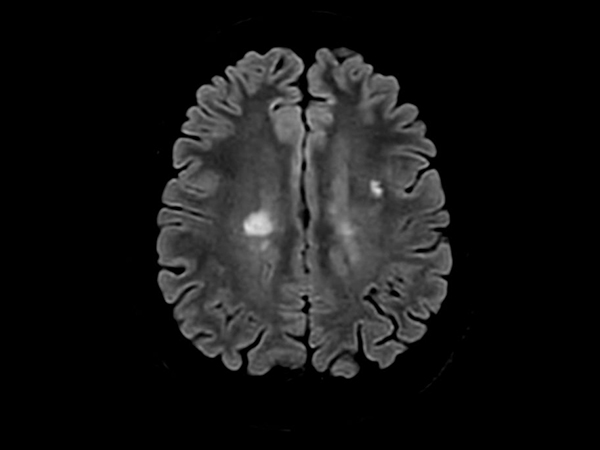 Сочетание метода изотропной 3D-визуализации с Compressed SENSE повышает разрешение изображений до 40% при том же времени сканирования