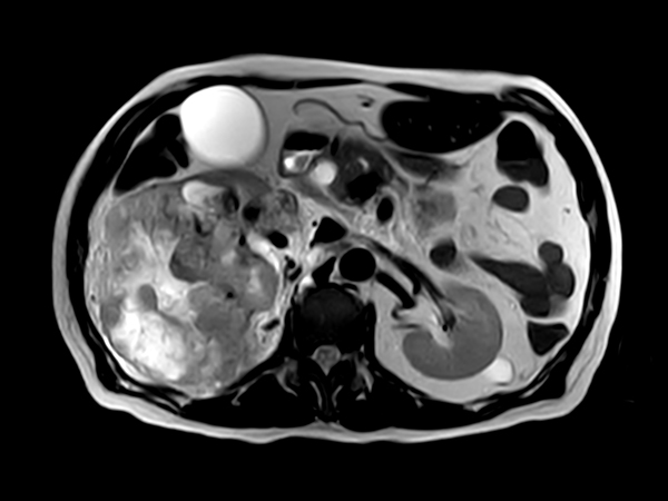 Шум при проведении исследований снижен на 80%. Технологию снижения шума ComforTone можно применять как в традиционных исследованиях мозга, позвоночника, ОДА, так и в исследованиях при высоких значениях градиентов.