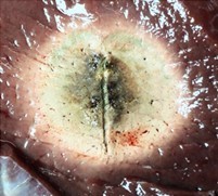 Система микроволновой абляции Dophi M150E поддерживает режим абляции одной иглой. Максимальная площадь абляции 4,5х4,5 см за 10 мин.