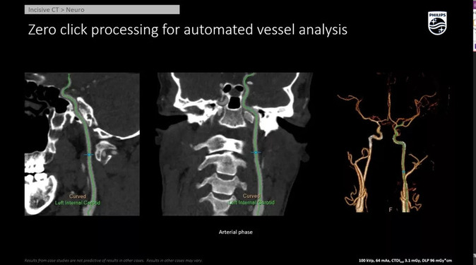 Система компьютерной томографии Philips Incisive CT