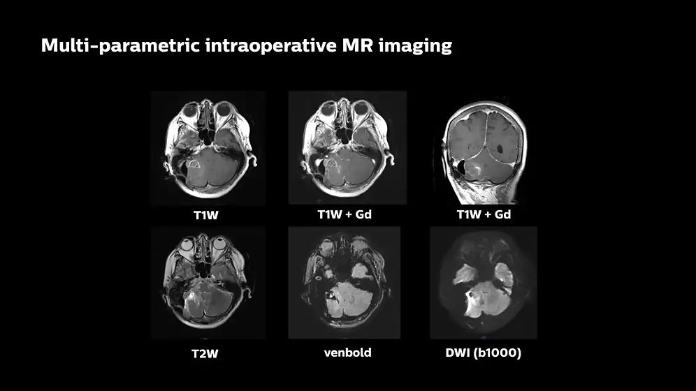 В основе интраоперационной МР-системы лежит сканер Philips Ingenia MR-OR 1.5T или 3.0T с цифровой широкополосной технологии dStream, гарантирующей высокое качество изображений, в том числе четкую визуализацию границ опухолей и мозга для диагностики неврологических и онкологических заболеваний.