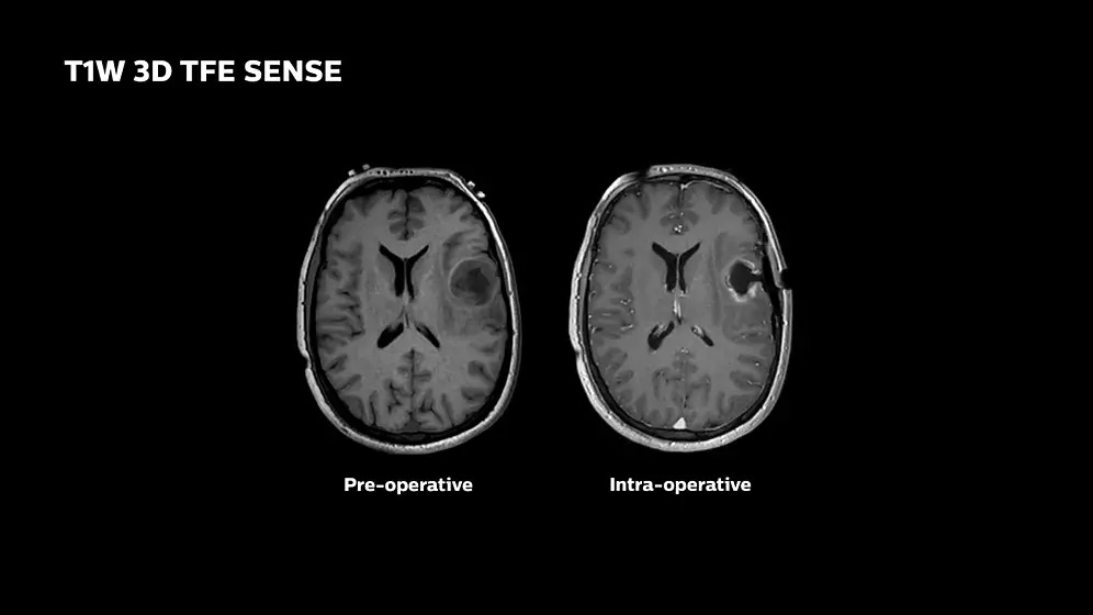 Применение Philips Ingenia MR-OR позволяет проводить операции в трех местах – операционной, с передней и с задней стороны магнита. Это облегчает биопсию головного мозга под контролем МРТ и функциональные нейрохирургические процедуры, включая размещение глубоких стимуляторов мозга.