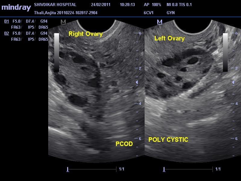 Мфя в гинекологии что. УЗИ мультифолликулярных яичников. Синдром поликистозных яичников УЗИ. Мультифолликулярные яичники на УЗИ. Поликистоз яичников УЗИ критерии.