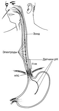 Установка ZрН-зонда с одним рН-электродом в пищеводе