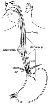 Установка ZрН-зонда с двумя рН-электродами в пищеводе