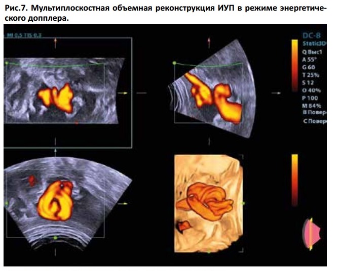 УЗ диагностика истинного узла пуповины