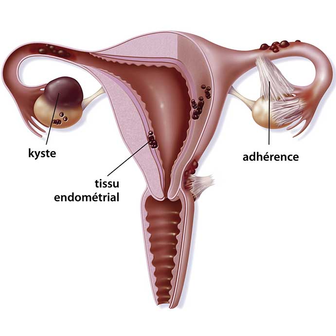 Бесплодие ассоциированное с эндометриозом яичников